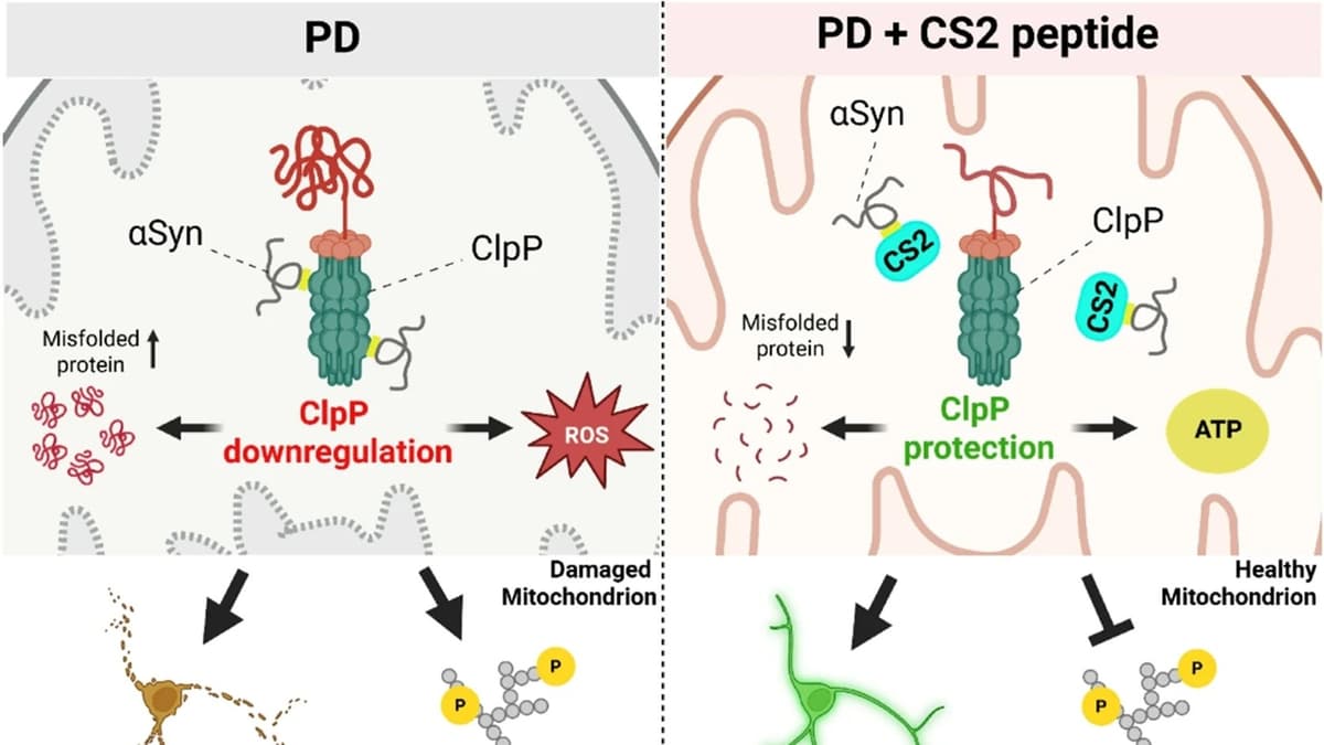 ค้นพบ 'จิ๊กซอว์ที่หายไป' ของโรค Parkinson's พร้อมยาต้านตัวใหม่ CS2